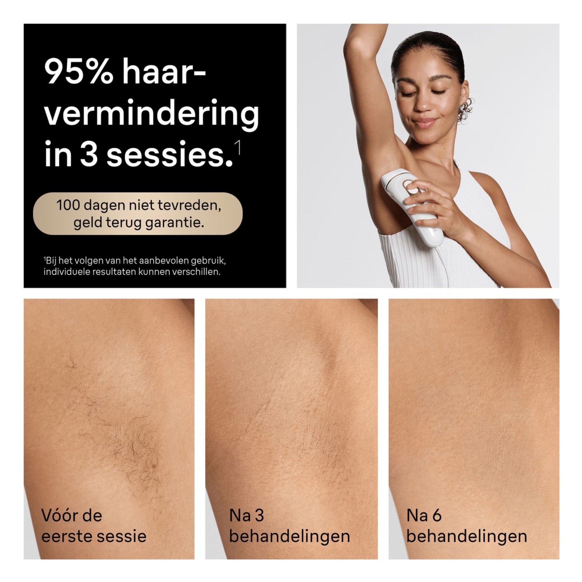 95 procent haarvermindering na 3 sessies met Braun IPL apparaat